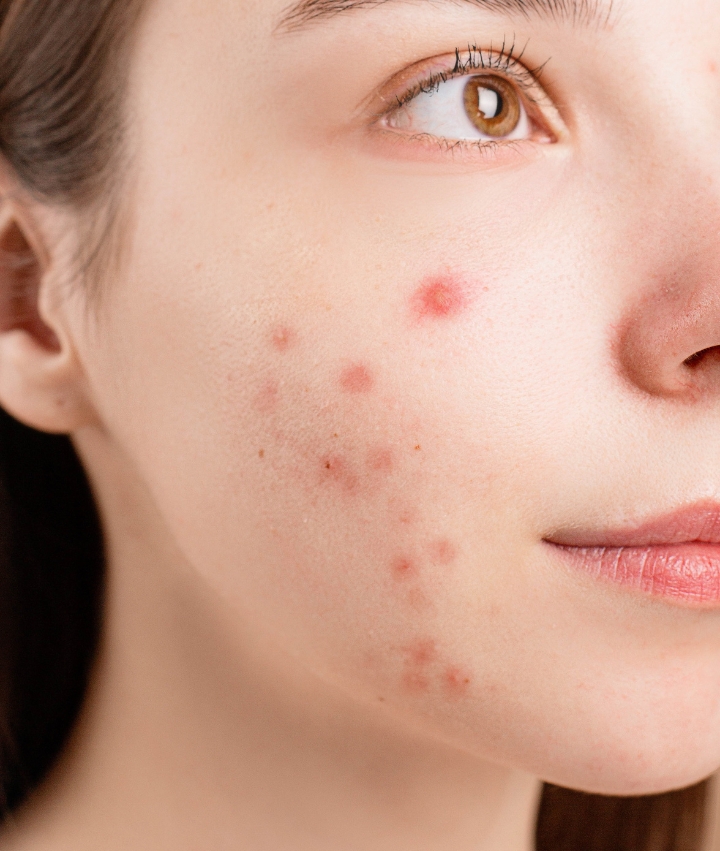 Acne scar removal Best acne scar treatments near me Stafford