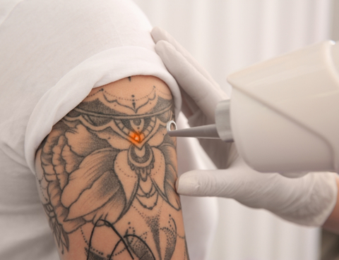 Tattoo removal for old or unwanted ink Stafford