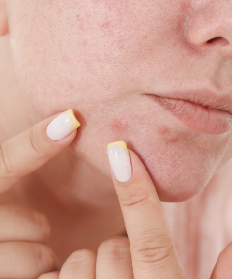 Med spa Stafford TX Professional acne scar removal med spa