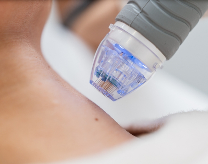 Can RF Microneedling Tighten Loose Skin?