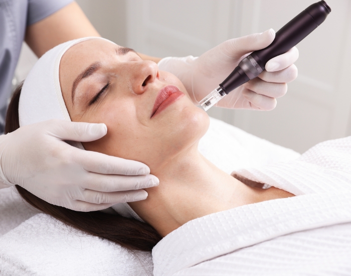 How Long Does RF Microneedling Last?