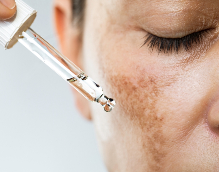 Why Are Dark Spots Appearing on My Face?