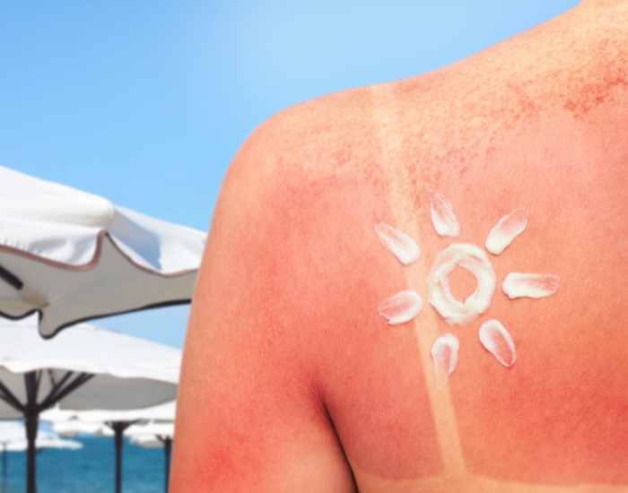 Best Treatment for Sun Damaged Skin