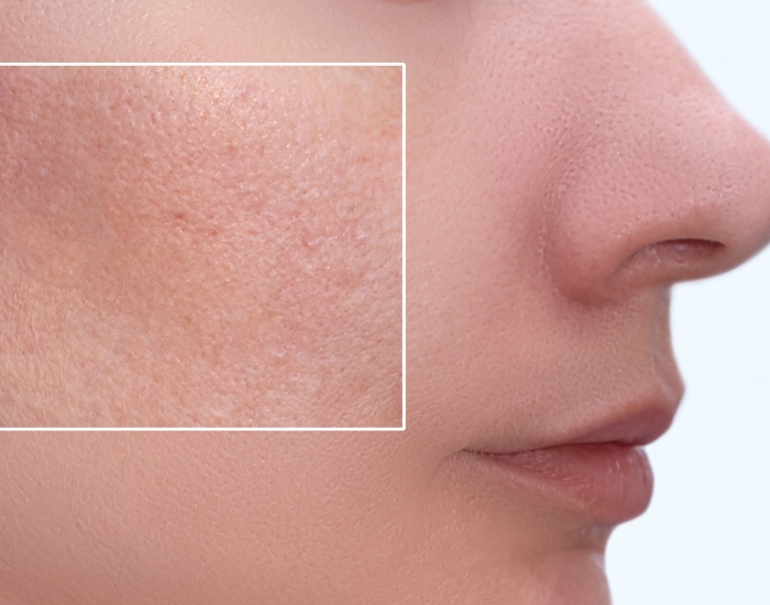 Why Are My Pores Getting Bigger?